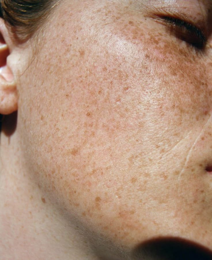 Melasma Tem Cura? Tudo o que Você Precisa Saber Antes de Tratar